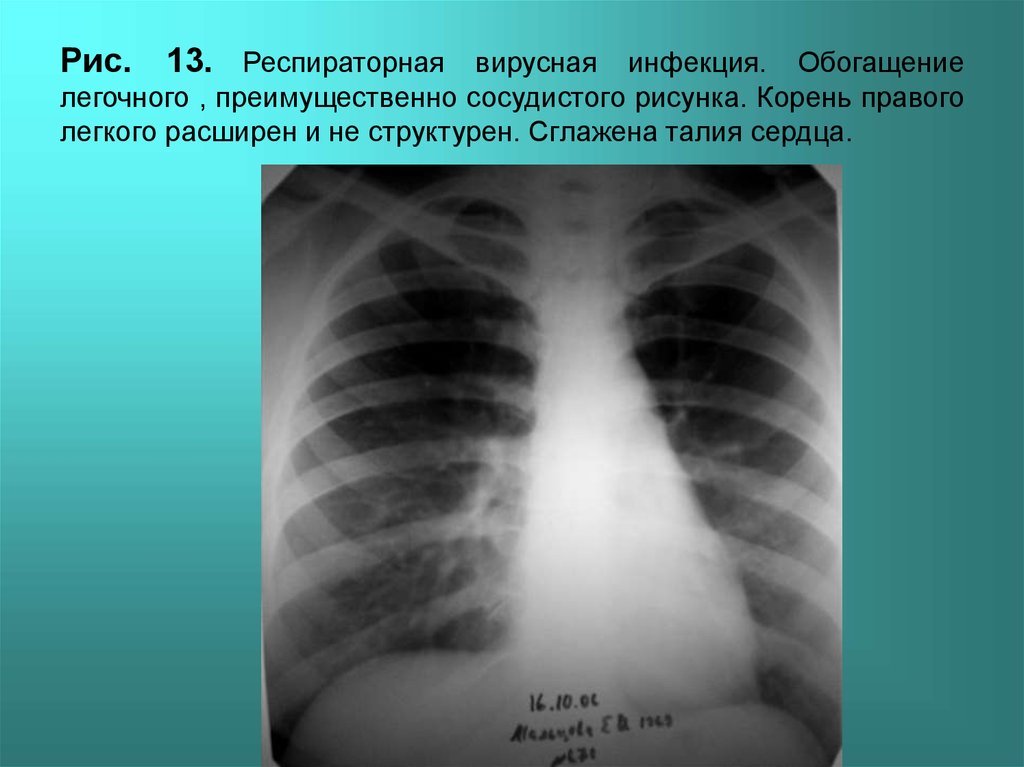 Обогащение легочного рисунка (50 фото) скачать бесплатно